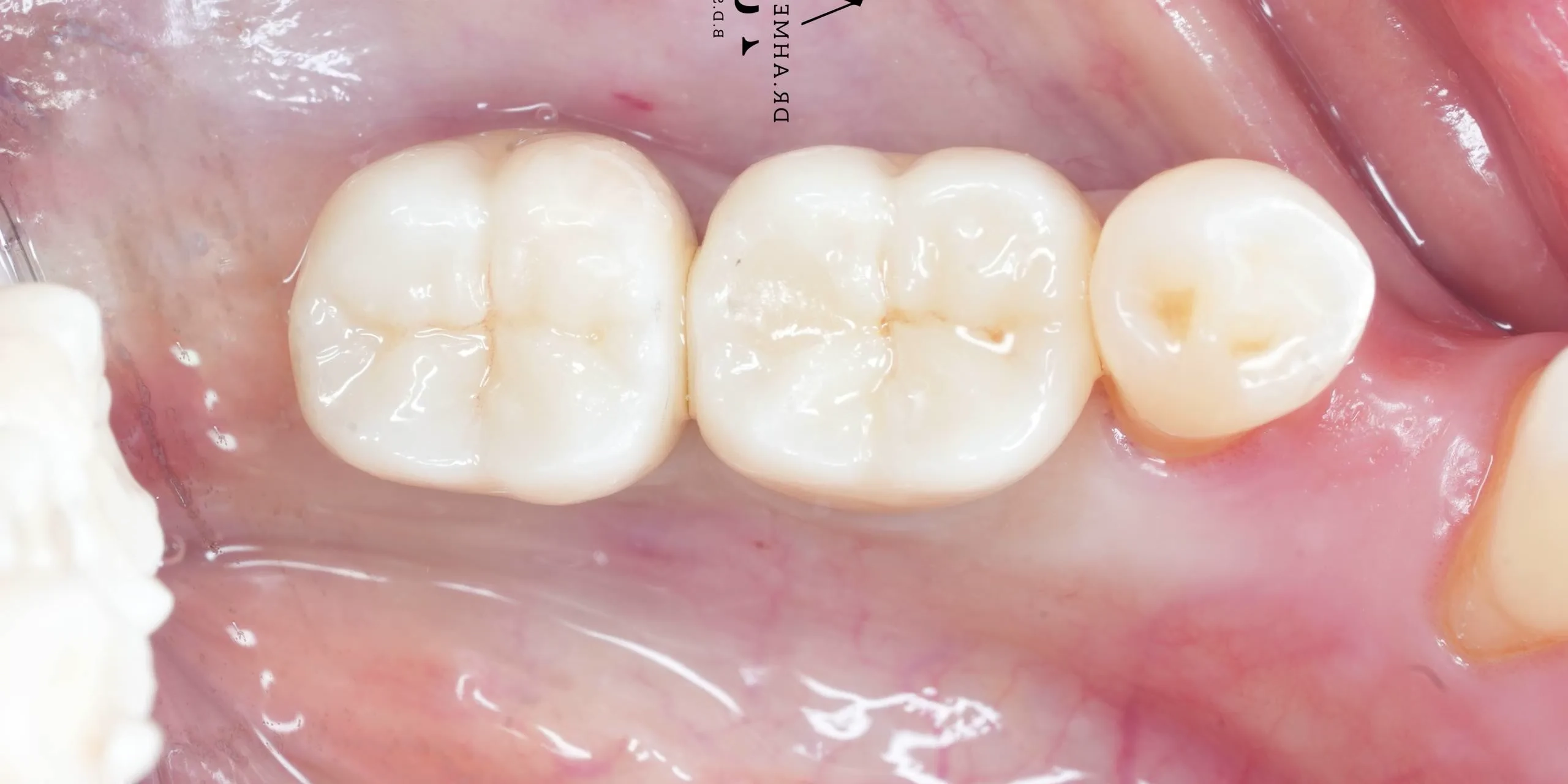 dr-ahmed-jamil-4-after.webp