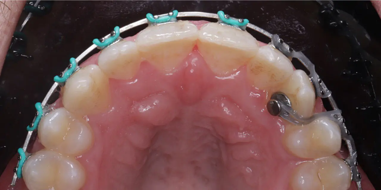 dr-alaa-3-after.webp