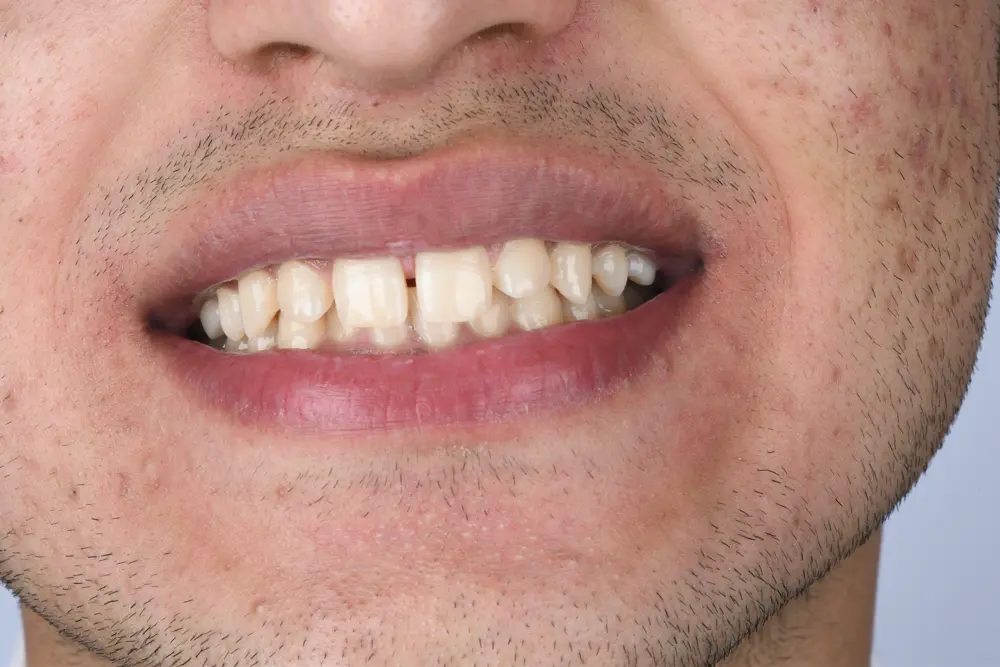 Before Image