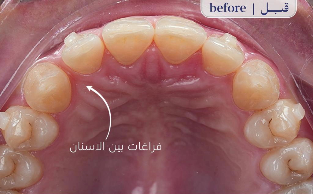 Before Image