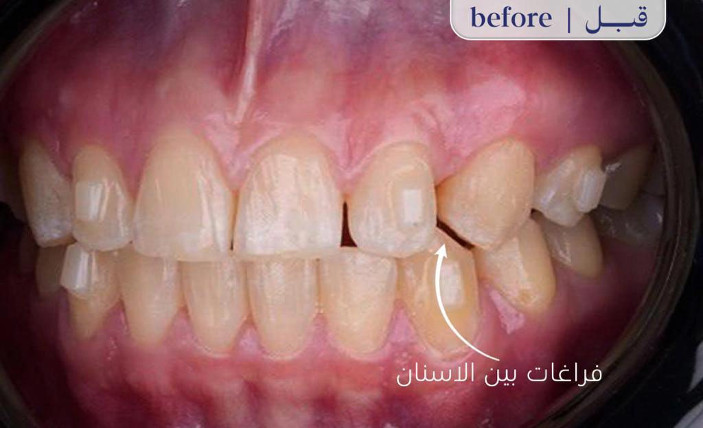 Before Image